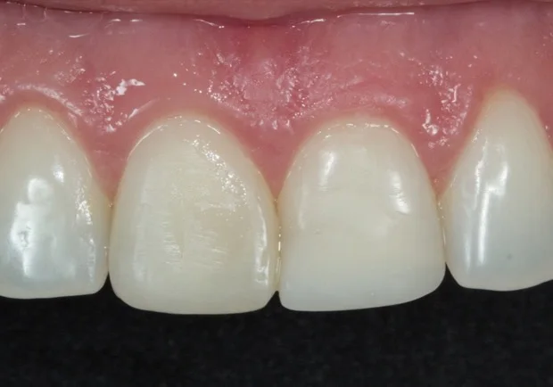 Antes: resinas antigas com forma e cor inadequadas