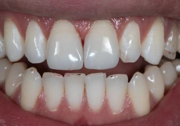 Depois: sorriso do paciente após as facetas